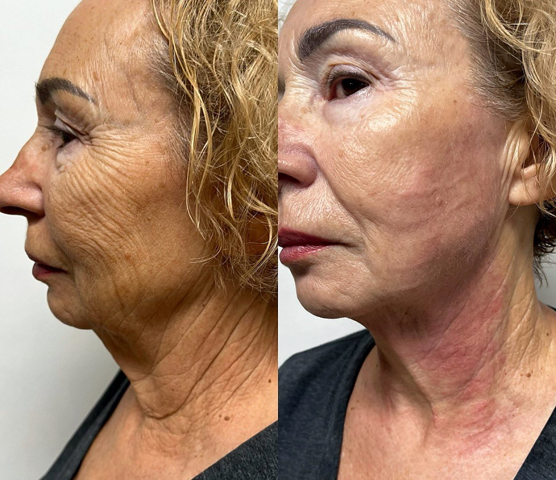 Before and after Ultherapy for neck skin tightening at GetSkin Medical Spa, Hallandale Beach FL