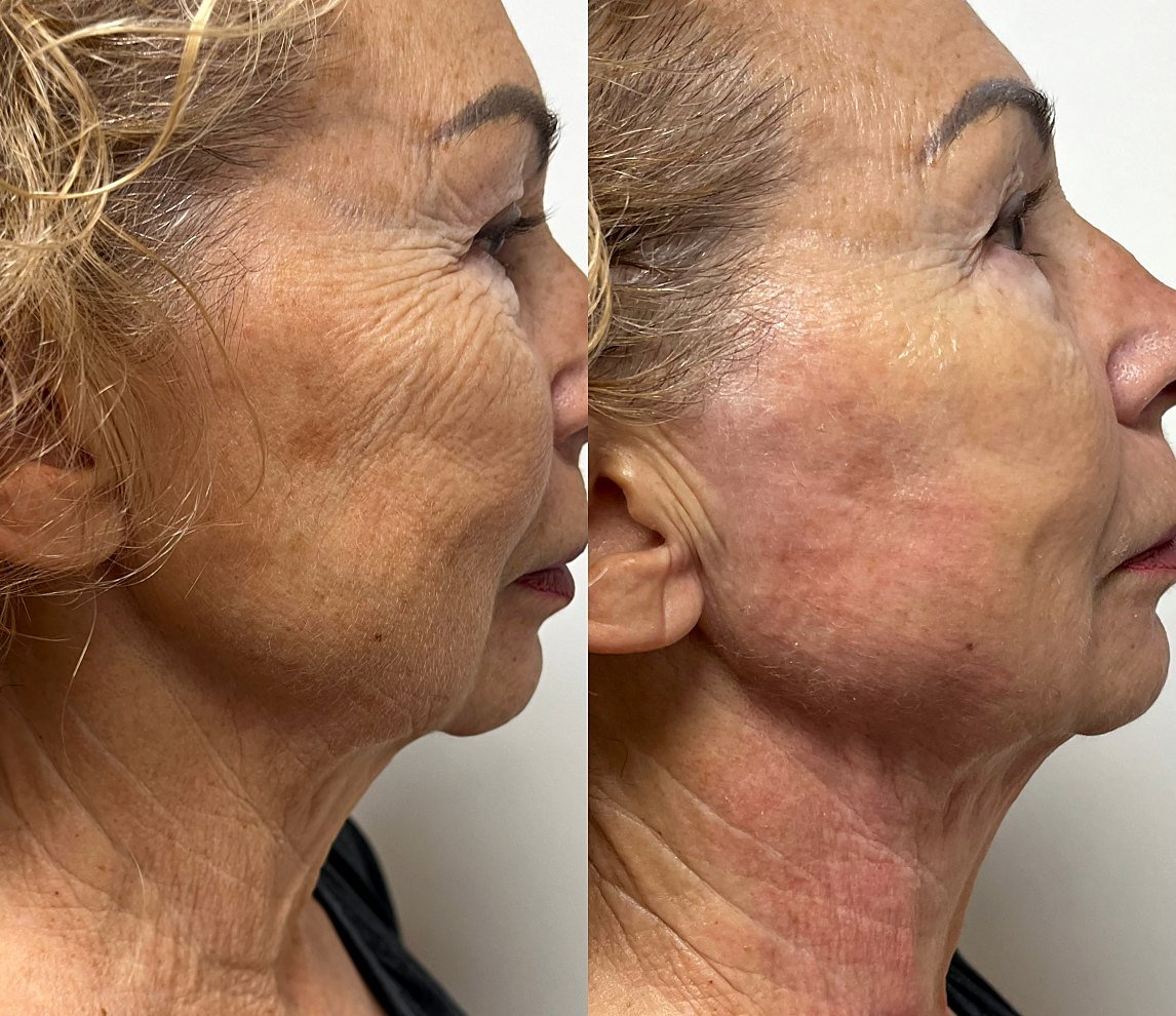 Before and after Ultherapy for neck lifting and lower-face firmness at GetSkin Medical Spa, Hallandale Beach FL
