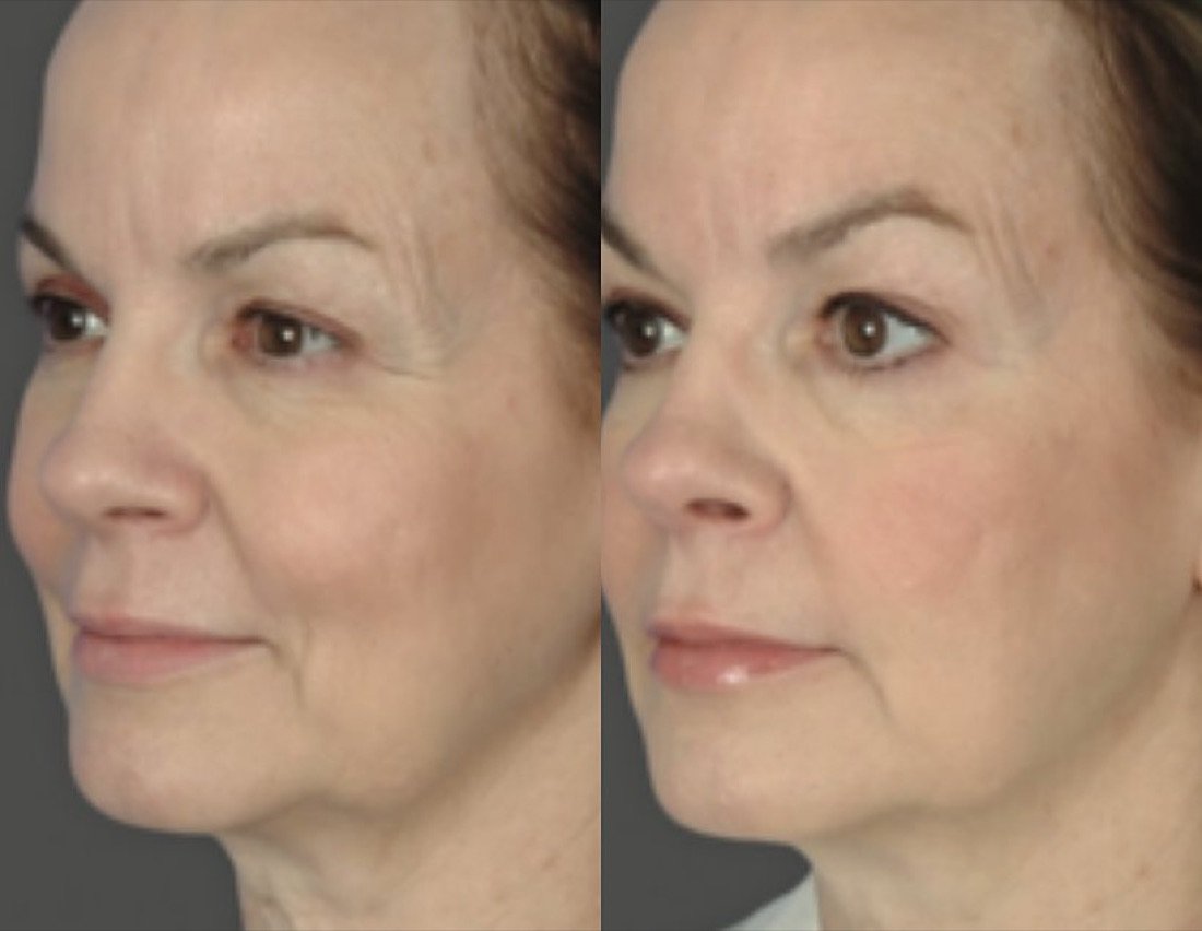 Before and after Ultherapy for wrinkles and skin firmness at GetSkin Medical Spa, Hallandale Beach FL